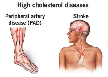 Exactly how Do You Lead to Cholesterol?
