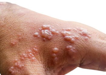 Sud-Kivu-Santé : Le Monkeypox signalé dans certaines Zones de santé du territoire de Kalehe