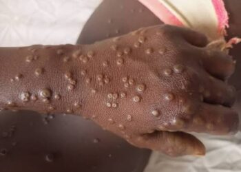 RDC/Santé : les Etats-Unis offrent 50 000 doses de vaccin au pays pour lutter contre le M-Pox 