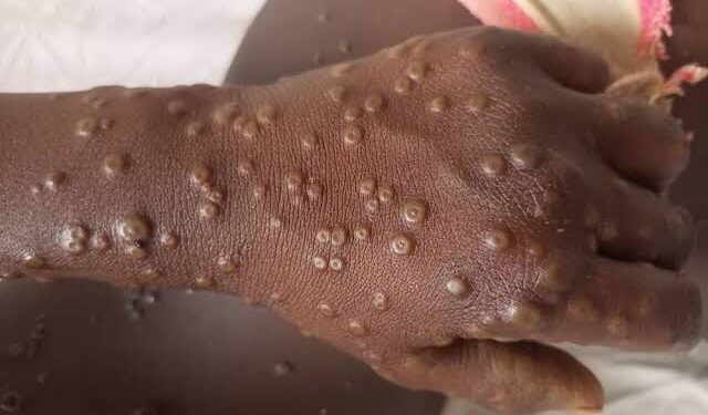 RDC/Santé : les Etats-Unis offrent 50 000 doses de vaccin au pays pour lutter contre le M-Pox 